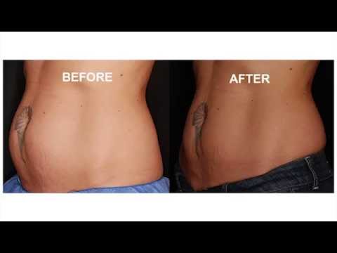 The Benefits of Coolsculpting – Western Dermatology ABQ